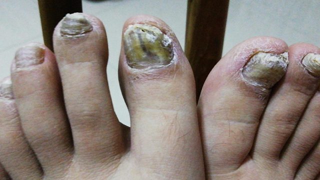 如何判断灰指甲？（附解决办法）