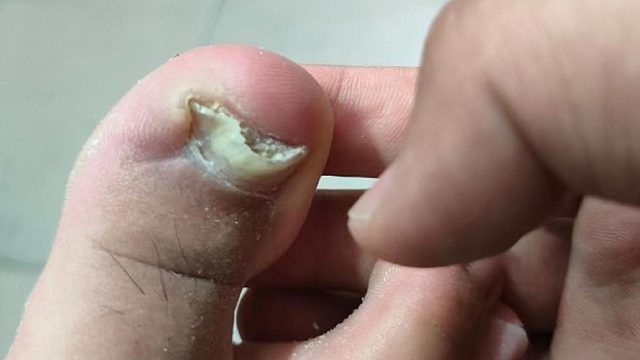 得了灰指甲别拖！3个祛灰产品任用一个，坏甲自动脱落！