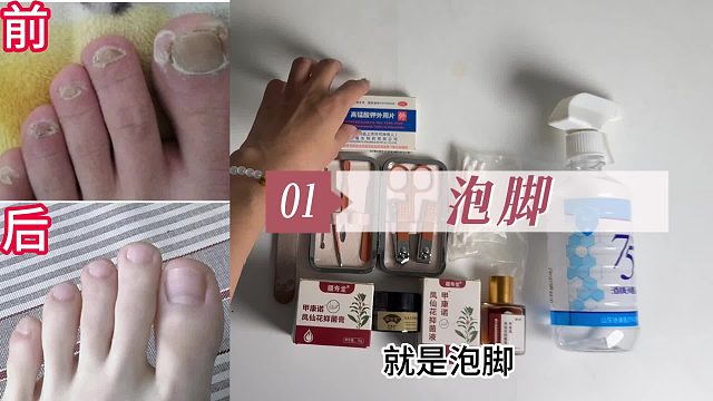 得了灰指甲太尴尬？这个步骤跟着做，在家分分钟摆脱它！
