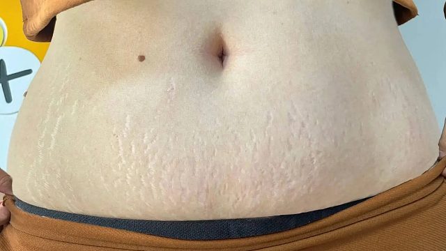 妊娠纹如何淡化？过来人亲测有效的妙招分享！皮肤瞬间光滑细腻！