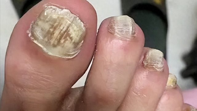 女生得灰指甲3年了（指甲增厚、发黄），求大神给个好方法！