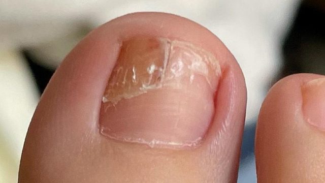 灰指甲最佳治疗时机已到来！这3个方法学会一个，坏甲秒变新甲！