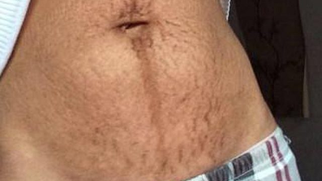 产后妊娠纹如何修复？3个淡纹产品赶紧用！皱纹遇见“躲着走”！