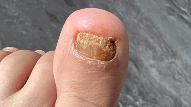 用最少的钱治好灰指甲！（实用版）