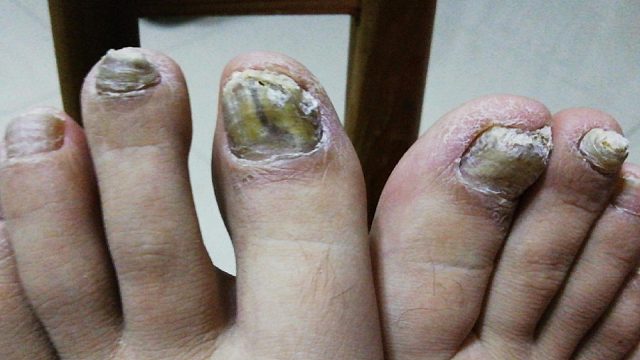 别再花冤枉钱了！学会这招，泛黄增厚的灰指甲秒变健康新甲！