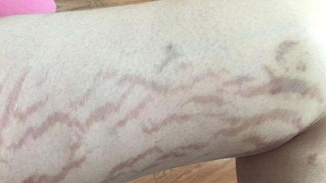 肥胖纹如何去除？过来人分享自用妙招！在家跟“纹纹”say拜拜！