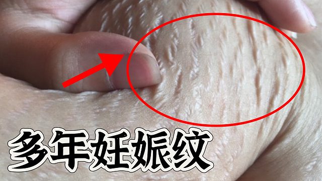 多年白色妊娠纹还有救吗？宝妈教你2个居家淡化方法！建议收藏！