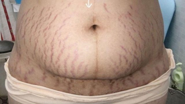 产后紫红色妊娠纹怎么祛？过来人3招教你解决！皮肤状态100%！