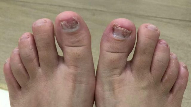 灰指甲最佳治愈时间已到来！3个国货抑菌好物快用！坏甲刷刷掉！