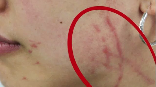 划伤留下的新生疤痕，需不需要治疗？这些人要注意啦