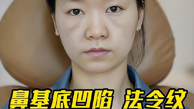 不会移位猴化的【鼻基底凹陷】调整思路