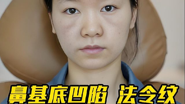 即刻小脸！鼻基底凹陷 法令纹 轮廓变美调整