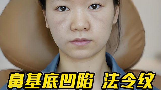即刻小脸！鼻基底凹陷 法令纹 轮廓变美调整