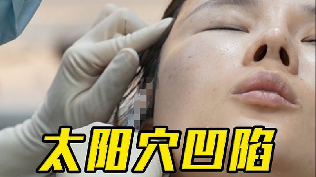 不会馒化的太阳穴凹陷改善思路，赶紧收藏！