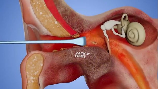 耳勺的工作原理