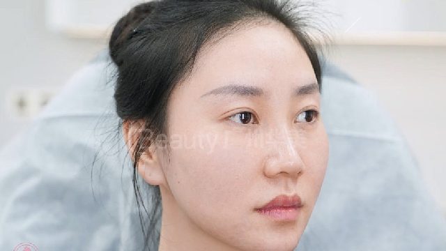 下巴后缩？微do一下即刻精致兜翘