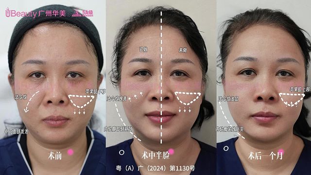 美拉美超声刀改变的不仅是轮廓，还有自信和气场