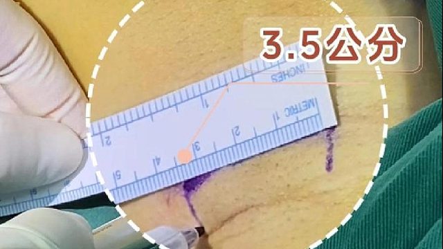 不想被男朋友看出来，做隆胸应该如何选择切口？