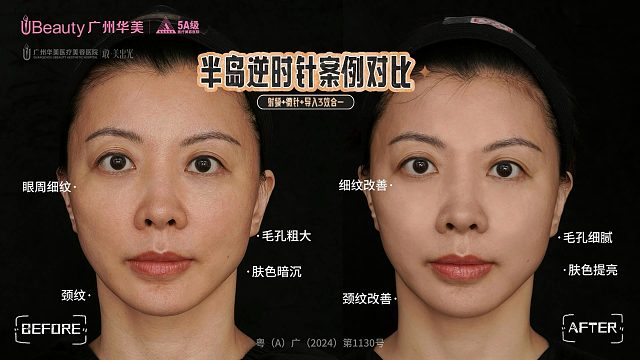 抗衰新选之「半岛逆时针」，华美院长亲自舒适体验