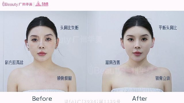 超模直角肩，夏天吊带、小背心放心穿，放肆美！