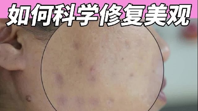 打水光烂脸留疤？看谢主任如何科学修复美观