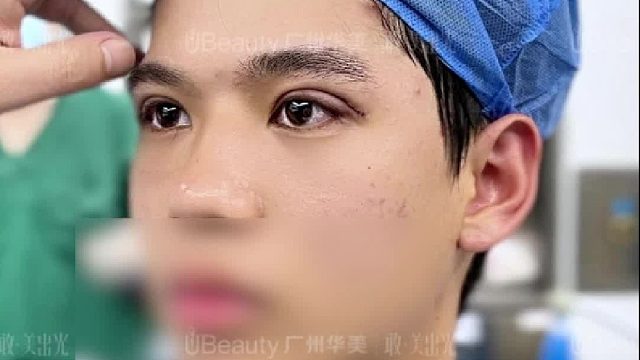 男生也能悄悄变帅！单眼皮变双眼皮，眼神瞬间有戏