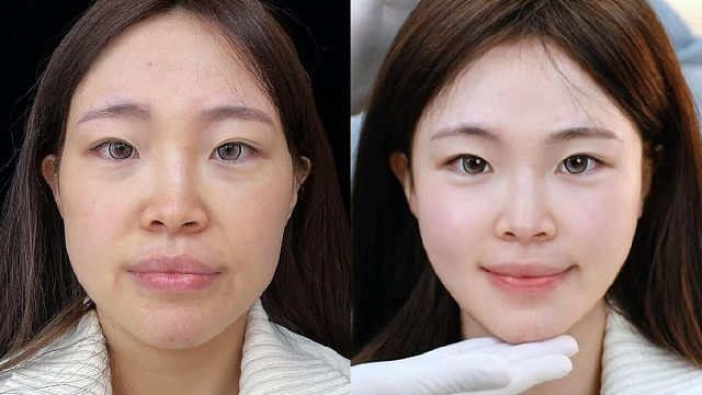 变美逆袭！苦相葫芦脸biu出甜妹幼态脸~