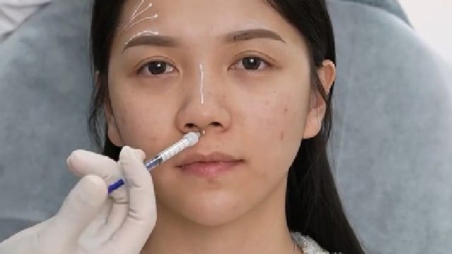 0整感！不开叨，只需1ml，爆改矮塌鼻