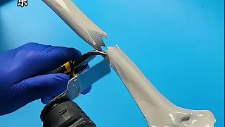 原來(lái)腿骨骨折是這樣修復(fù)的，看完真是漲知識(shí)了