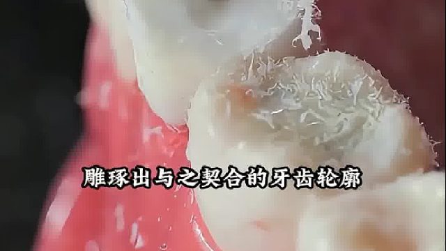 原来蛀牙断牙是这样修复的，看完真是涨知识了