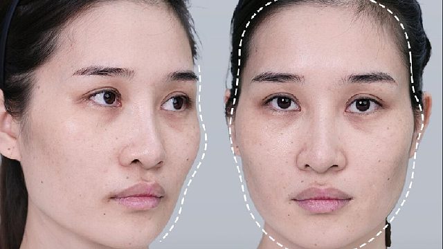 面部凹陷 颧骨突出？5个点位直接‘嘭’起来