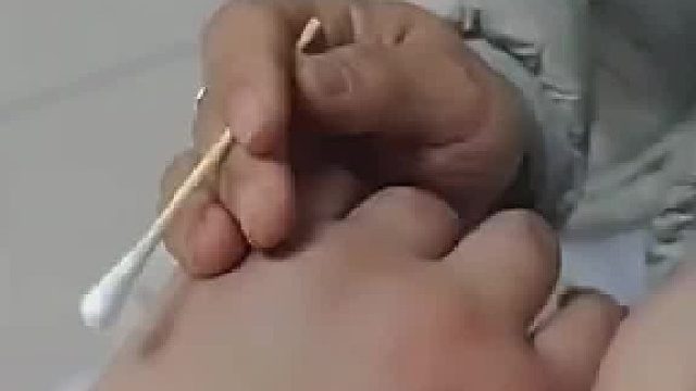 扎针时针管不小心断在里面，护士试图用棉签把它挤出来