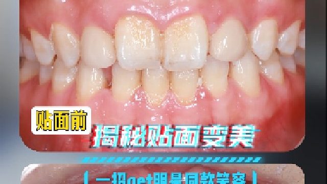 这牙贴面效果谁看了不说一句牛