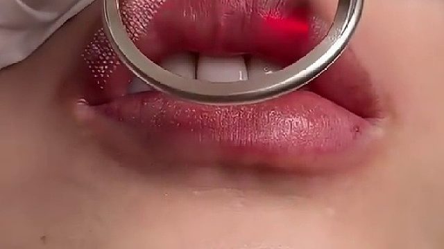 痔疮切割手术？