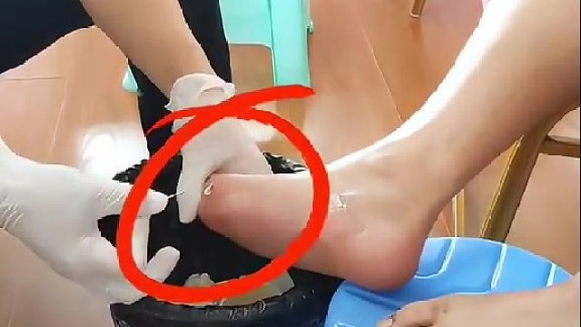 海鲜配啤酒，痛风结石跑不了