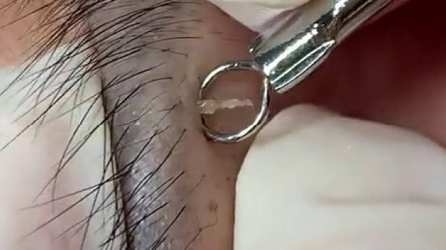 给客户挤痘痘，他爽不爽我不知道我是解压了