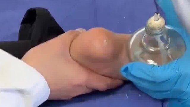 小男孩脚底板长出跖疣，火针治疗时孩子疼得全身颤抖，网友：感觉开了疼痛共享