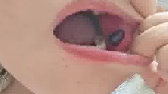 女子刚出了两片薯片，没想到不到一分钟嘴里立马长出了大血泡