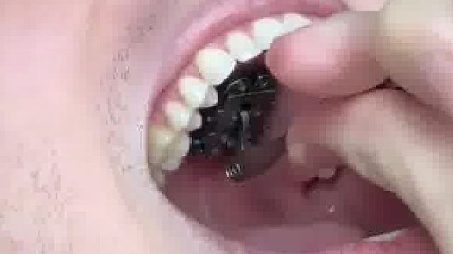 外国网友分享自己带上颚扩弓器一幕