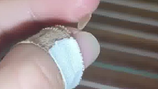 古筝考试前一天练习时，小拇指的老茧竟然练脱落了