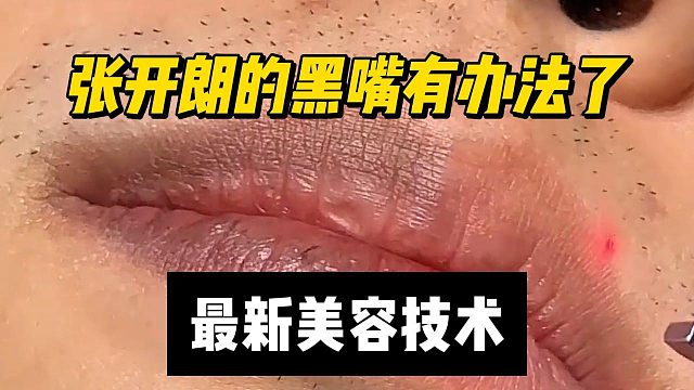 张开朗的黑嘴有办法了，最新美容技术