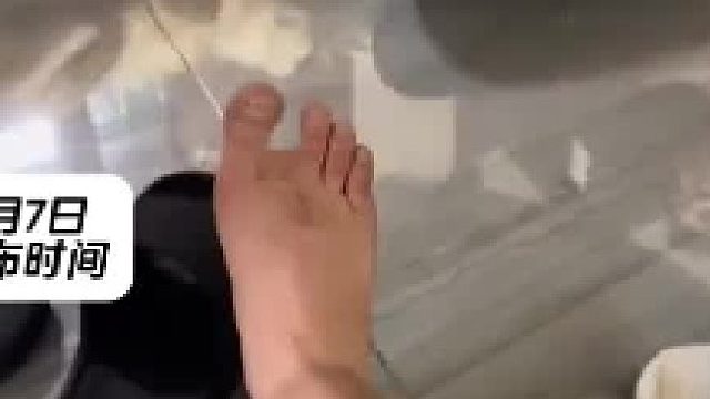 因意外失去大拇指,通过手术把脚趾移到手上,网友_想知道手会长脚气吗