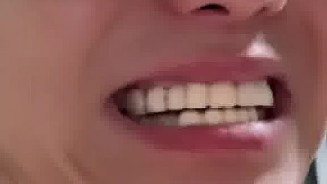 为了牙齿的美观做了一套临时牙，称不用手舌头都会自己安装了，网友就怕你一个不注意给咽下去了