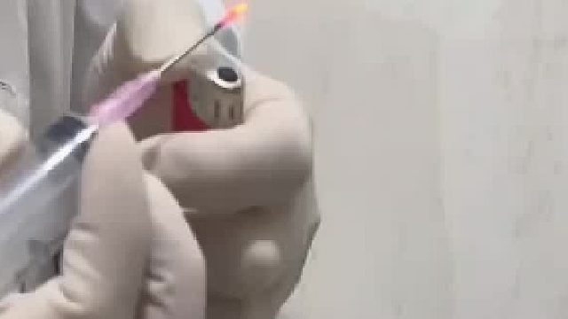 近距离观看甲下血肿引流术,用火把针烧红直接一针见血