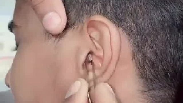 从外国小哥耳朵里拿出异物看着就好揪心​