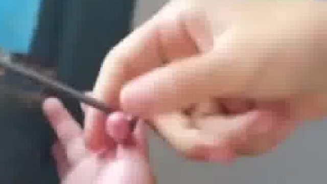 小宝宝大拇指多长了一块指头，玩耍时多余指头被卡住