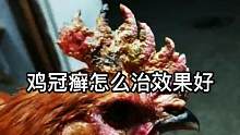 怎么治疗鸡冠癣