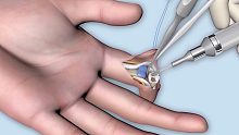 3D医学视频：指关节置换手术！