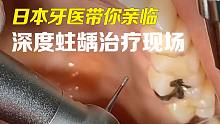 体验深度蛀牙现场！看看牙医如何做？