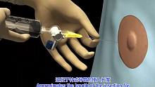 3D医学视频演示胸腔穿刺术